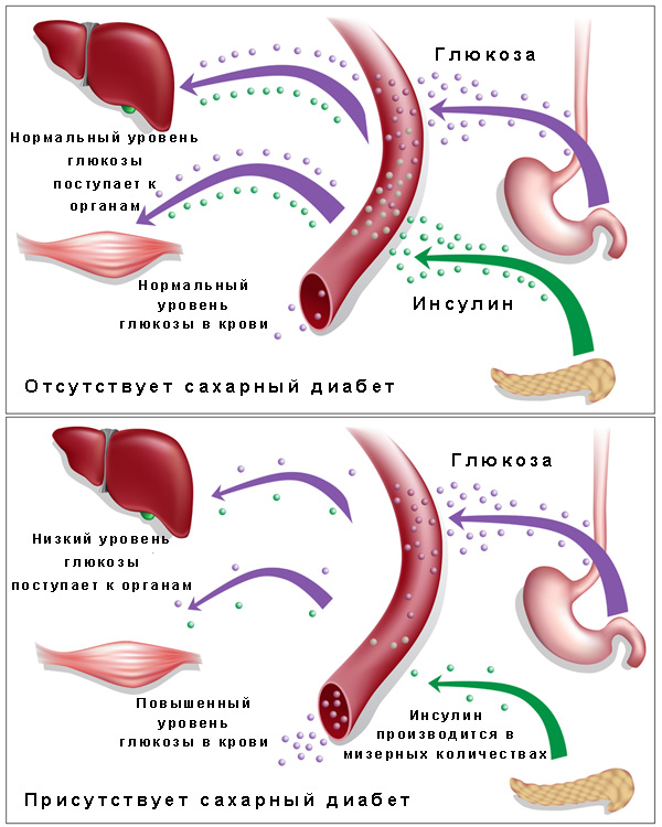 Сахарный диабет